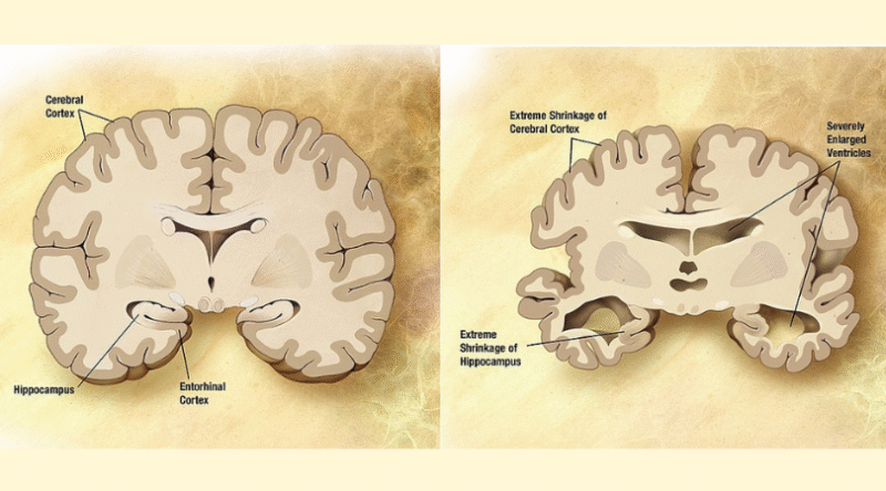 Alzheimer’s