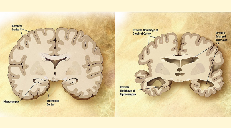 Alzheimer’s