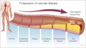 erectile dysfunction image