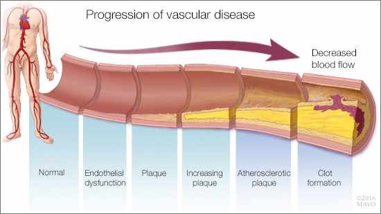 erectile dysfunction image