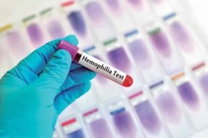 haemophilia test sample