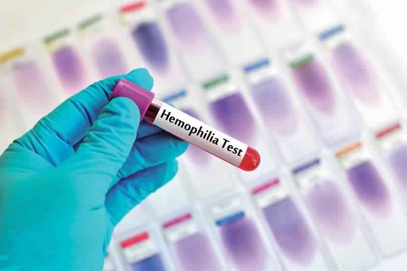 haemophilia test sample