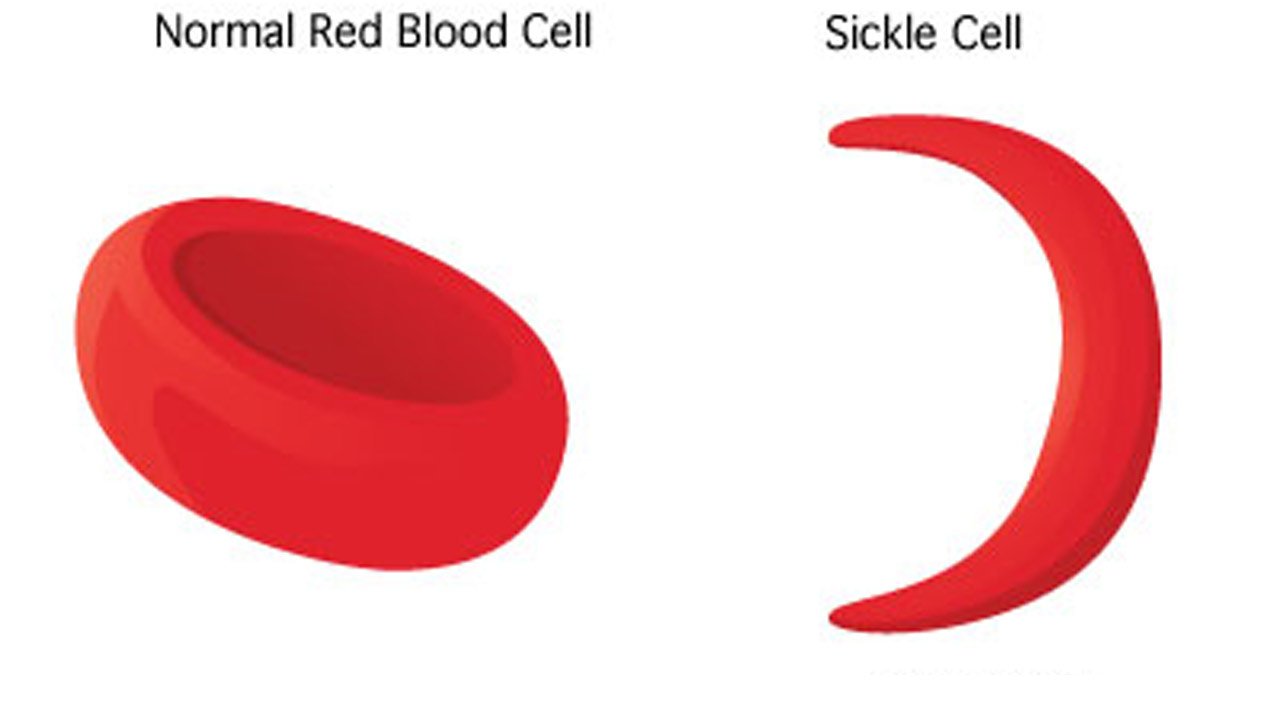 sickle cell disease