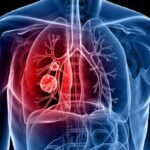 Lung Cancer