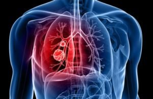 Lung Cancer