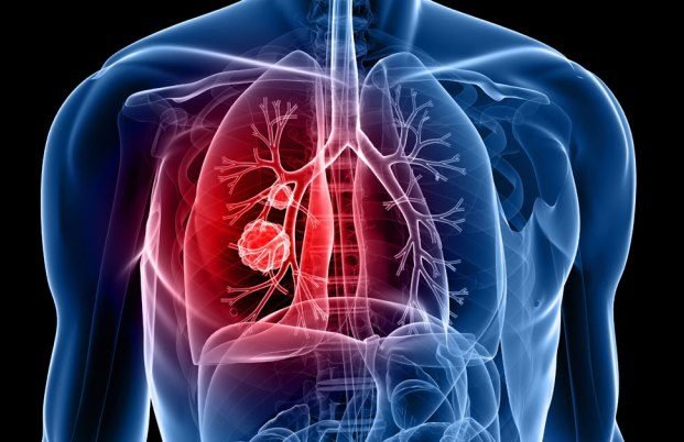 Lung Cancer