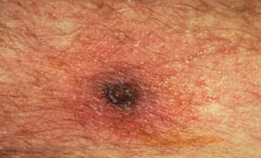 According to the CDC, symptoms of this disease a is just like any other viral fever.