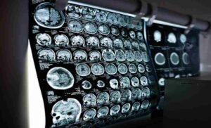 Dr Rahul Gupta Explores Advancements in Glioblastoma Treatment on Glioblastoma Awareness Day