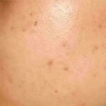 Hyperpigmentation: Root Cause, Preventive Measures And Solutions