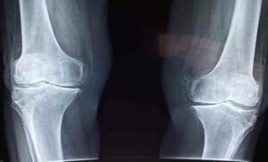 Advantages of Robotic Knee Replacement Surgery: Expert Insights on Precision and Faster Recovery