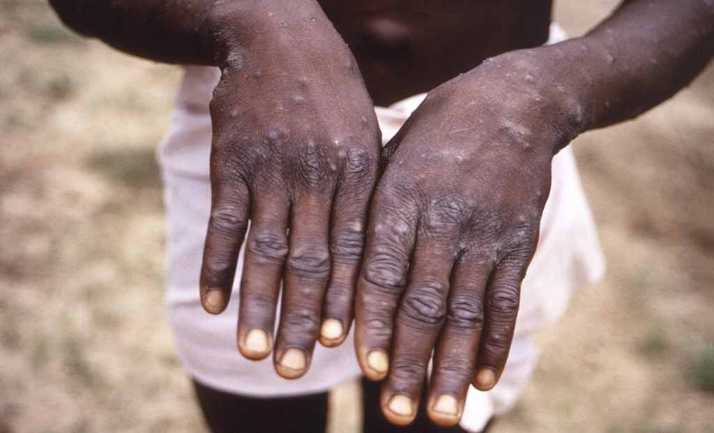 Monkeypox Case Reported in Delhi; Fourth Case in India