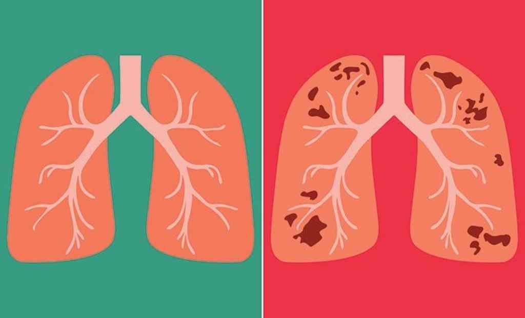 Study Reveals Increased Mortality Risk and Reduced Life Expectancy in Patients After Successful Tuberculosis Treatment