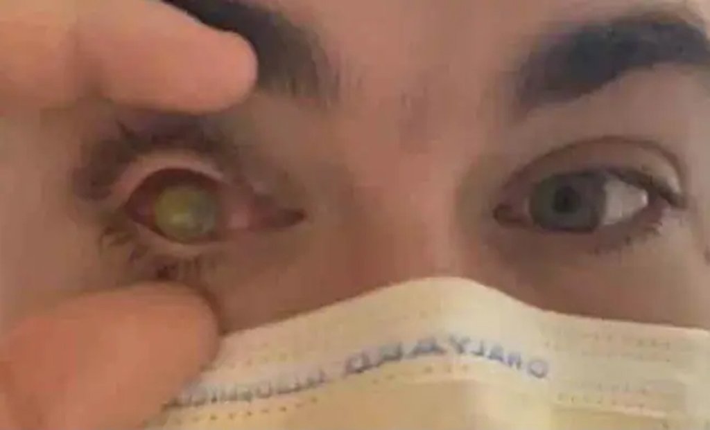 contact lens
