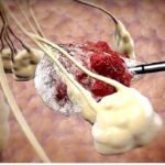 Cryoablation: A Game-Changing Cancer Treatment Arrives in North India