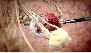 Cryoablation: A Game-Changing Cancer Treatment Arrives in North India