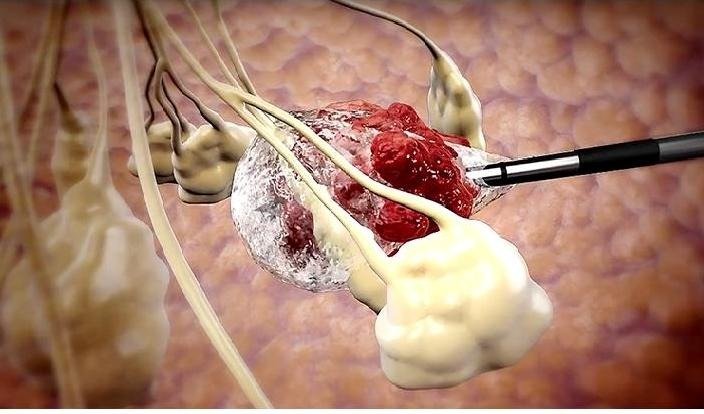 Cryoablation: A Game-Changing Cancer Treatment Arrives in North India