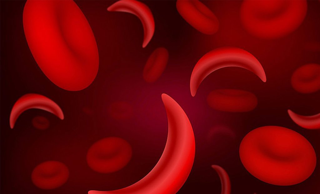 Sickle Cell