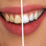 Number of teeth and the presence of gum disease were correlated with changes in the left hippocampus.