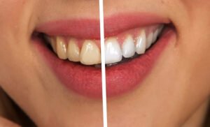 Number of teeth and the presence of gum disease were correlated with changes in the left hippocampus.