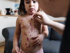 Measles Alert: Symptoms, Prevention Tips, and Everything You Need to Know