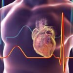 Stroke Prevention Tips