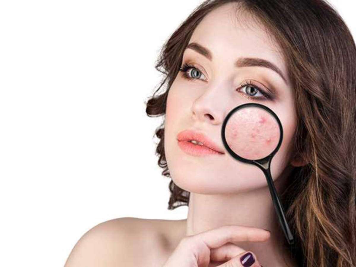 Five Overnight Treatments for Acne Using Natural Ingredients