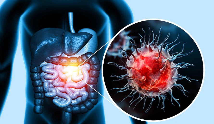 Alarming Trend: Colon Cancer Cases Soar in Under 50 Age Group