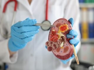 Kidney Stones Vs Gallbladder Stones: How To Differentiate The Two Conditions At Home?