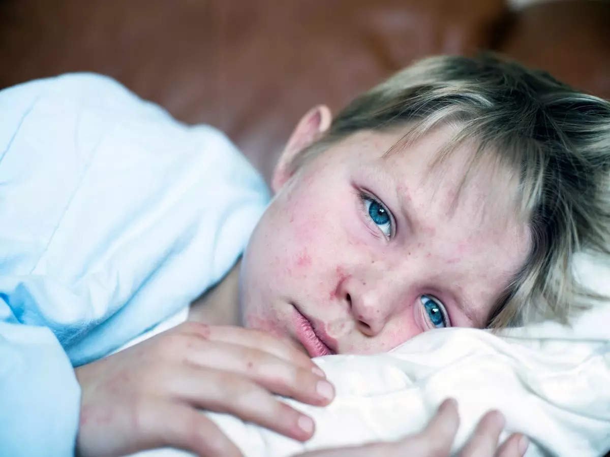 Measles Outbreak