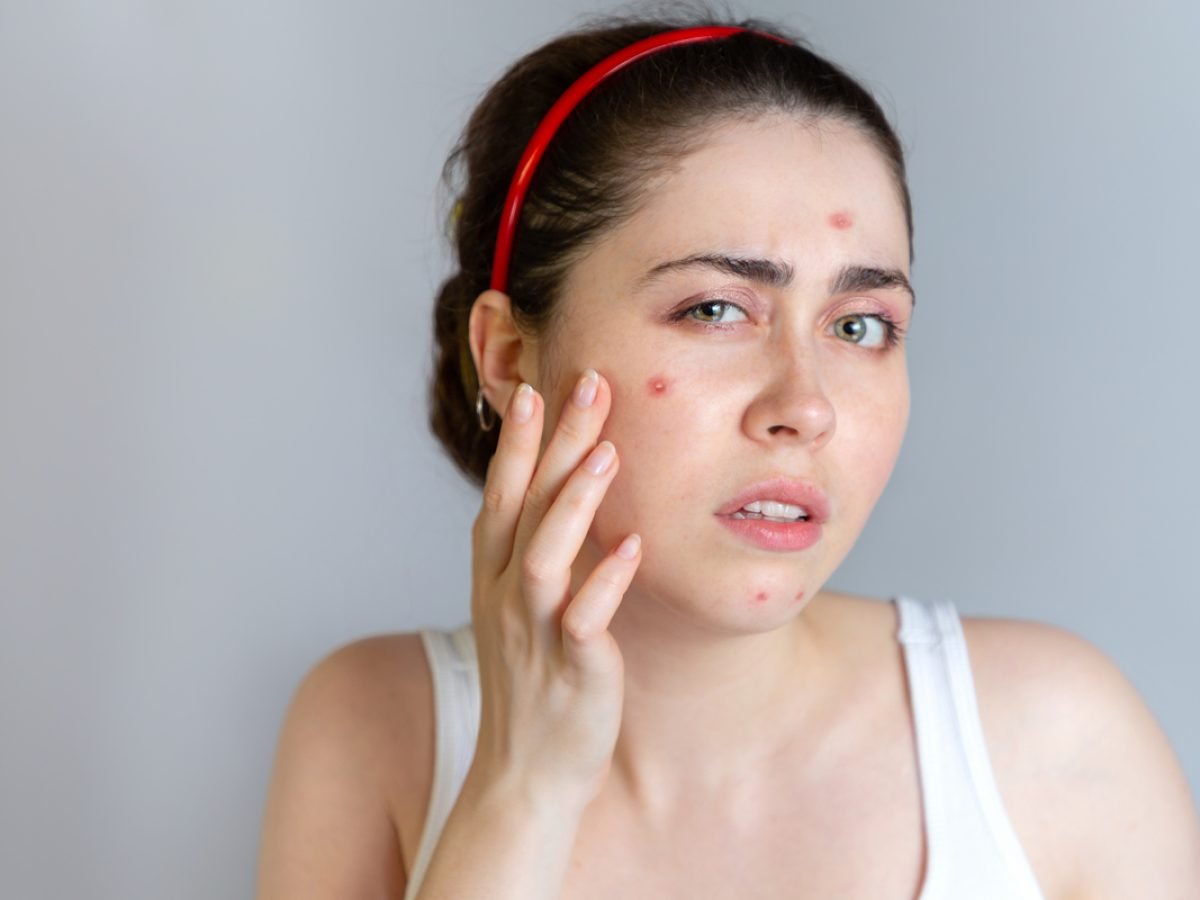 Expert Tips: Combat Acne During Monsoon with Effective Skincare Routine