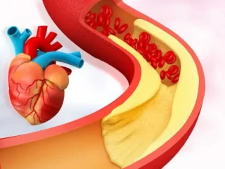 High Cholesterol And Heart Health: 5 Signs of Stroke You Should Never Ignore
