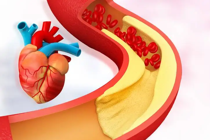 High Cholesterol And Heart Health: 5 Signs of Stroke You Should Never Ignore