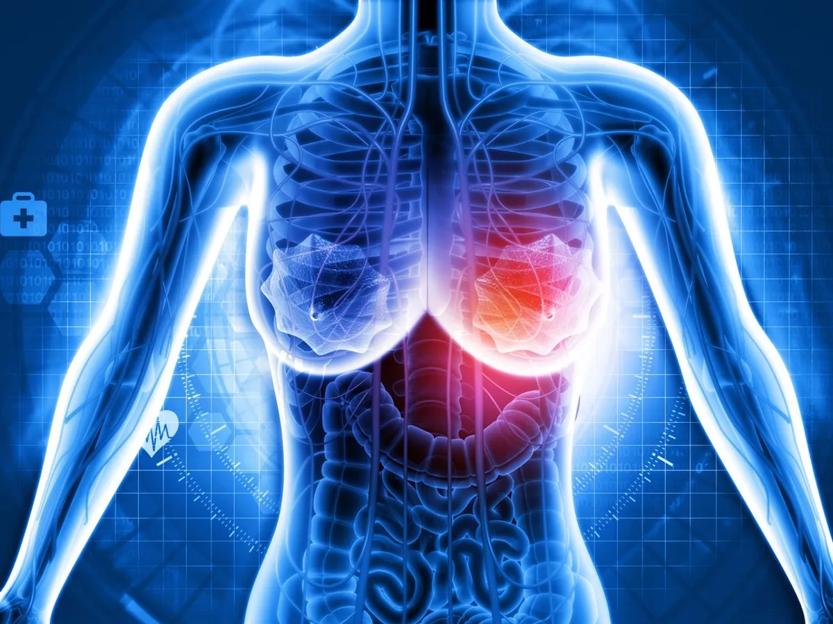 Breast Cancer