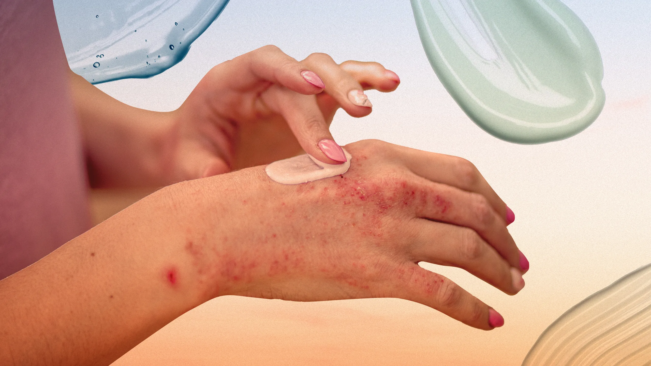 Psoriasis