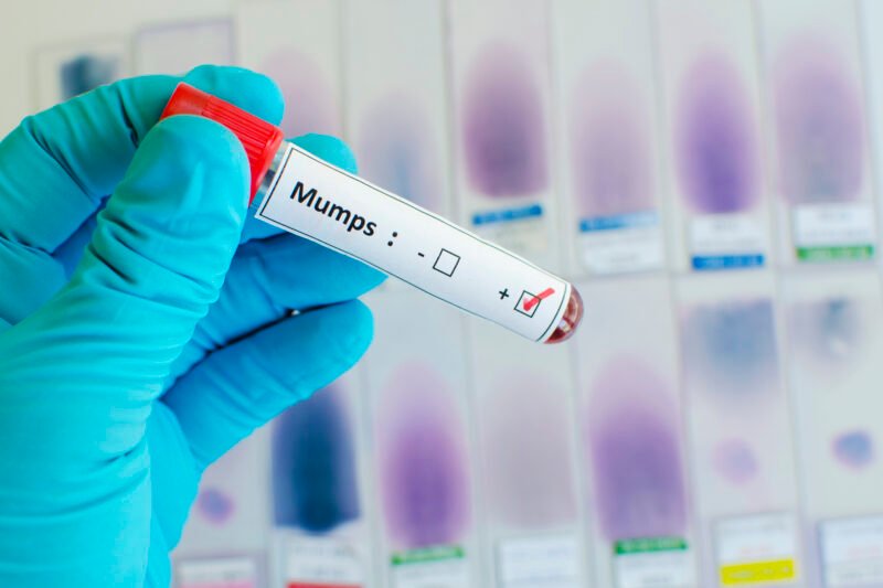 mumps