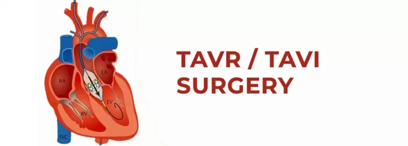 TAVI