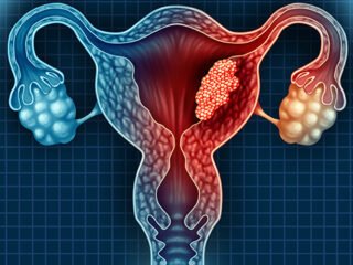 Uterine Fibroid