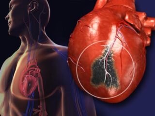 Heart Diseases In Women