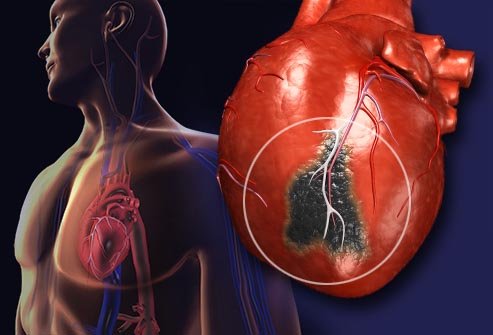 Heart Diseases In Women