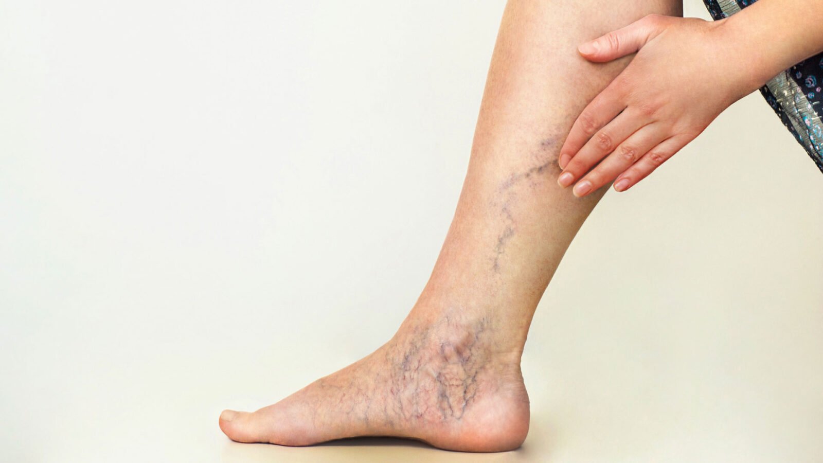 Chronic Venous Insufficiency
