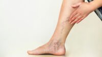 Chronic Venous Insufficiency